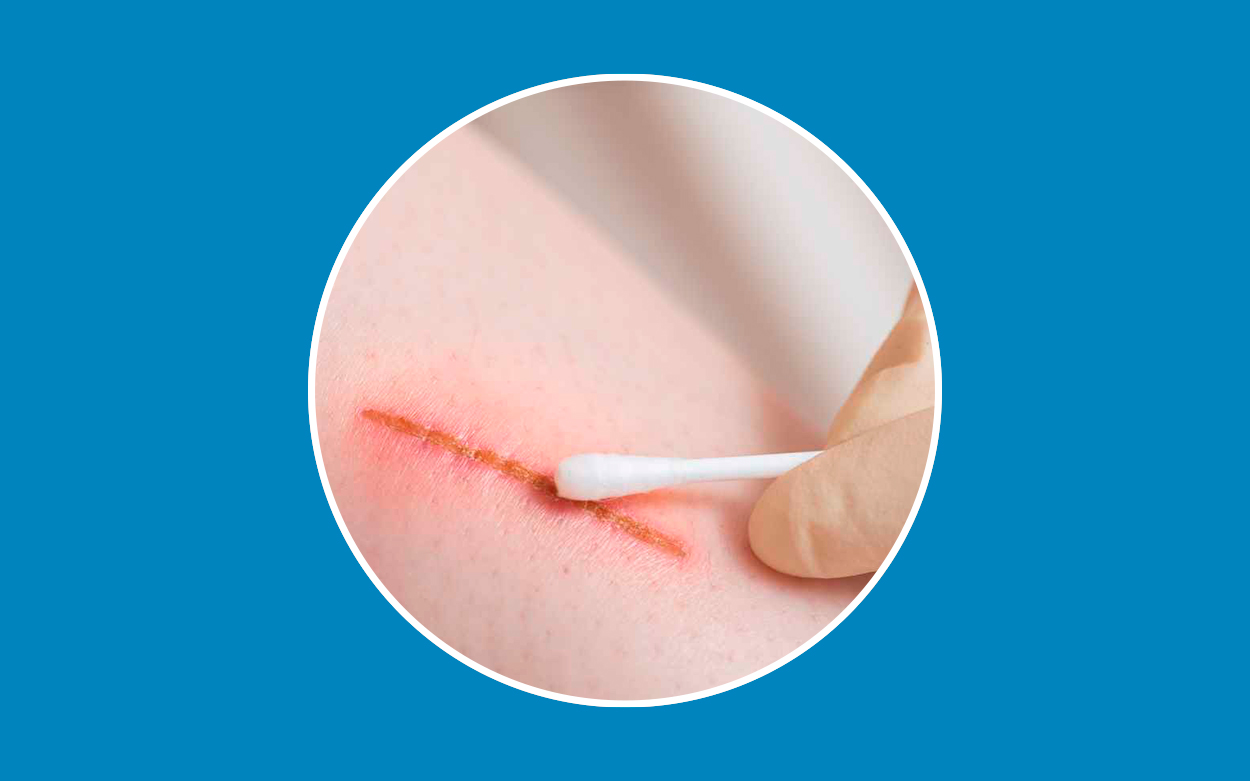 Pegamento para heridas: Adiós a las grapas y puntos de sutura | Bloygo